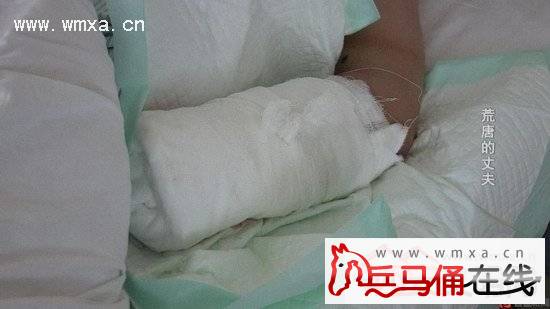 四川一偏执男剁妻子左手 原因竟是想变残疾人