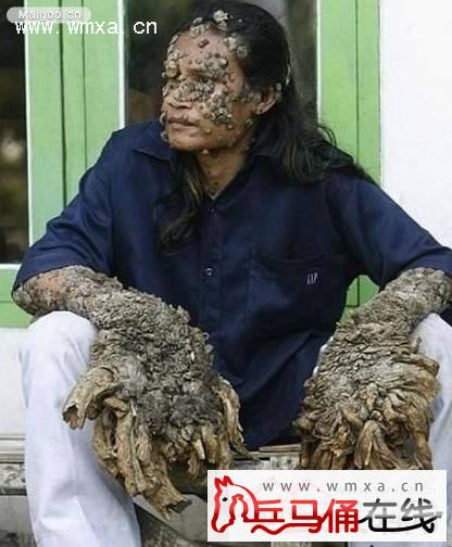孟加拉男子罕见病被嘲“树人” 十分吓人网友慎入(4)_西安文明网